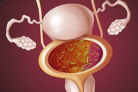 Emakume batean zistitis bakterioa